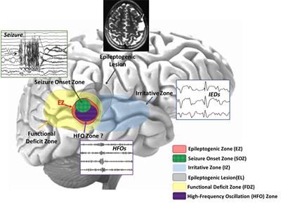 Current and Emerging Potential of Magnetoencephalography in the Detection and Localization of High-Frequency Oscillations in Epilepsy